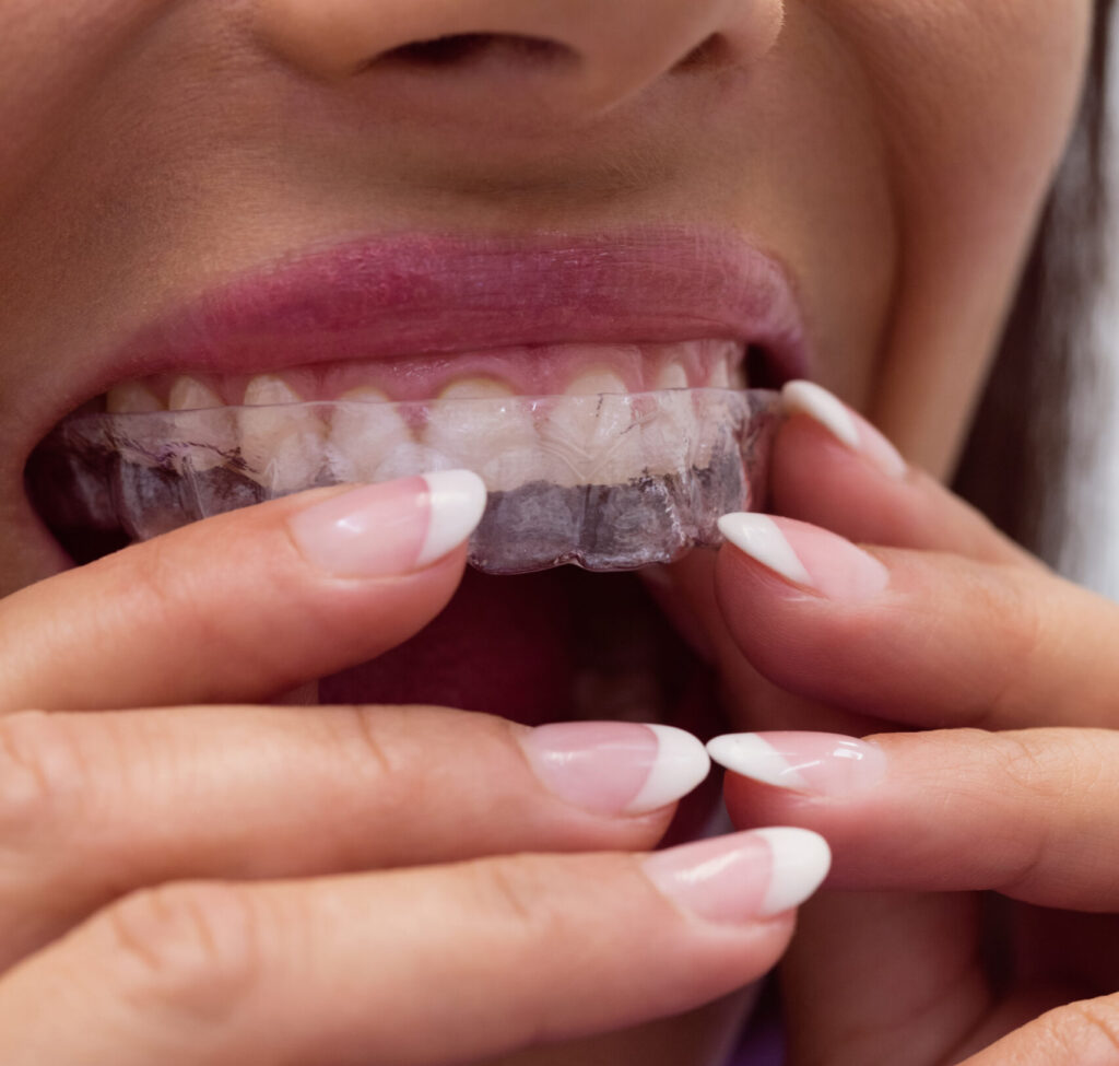 attachment na ortodontia